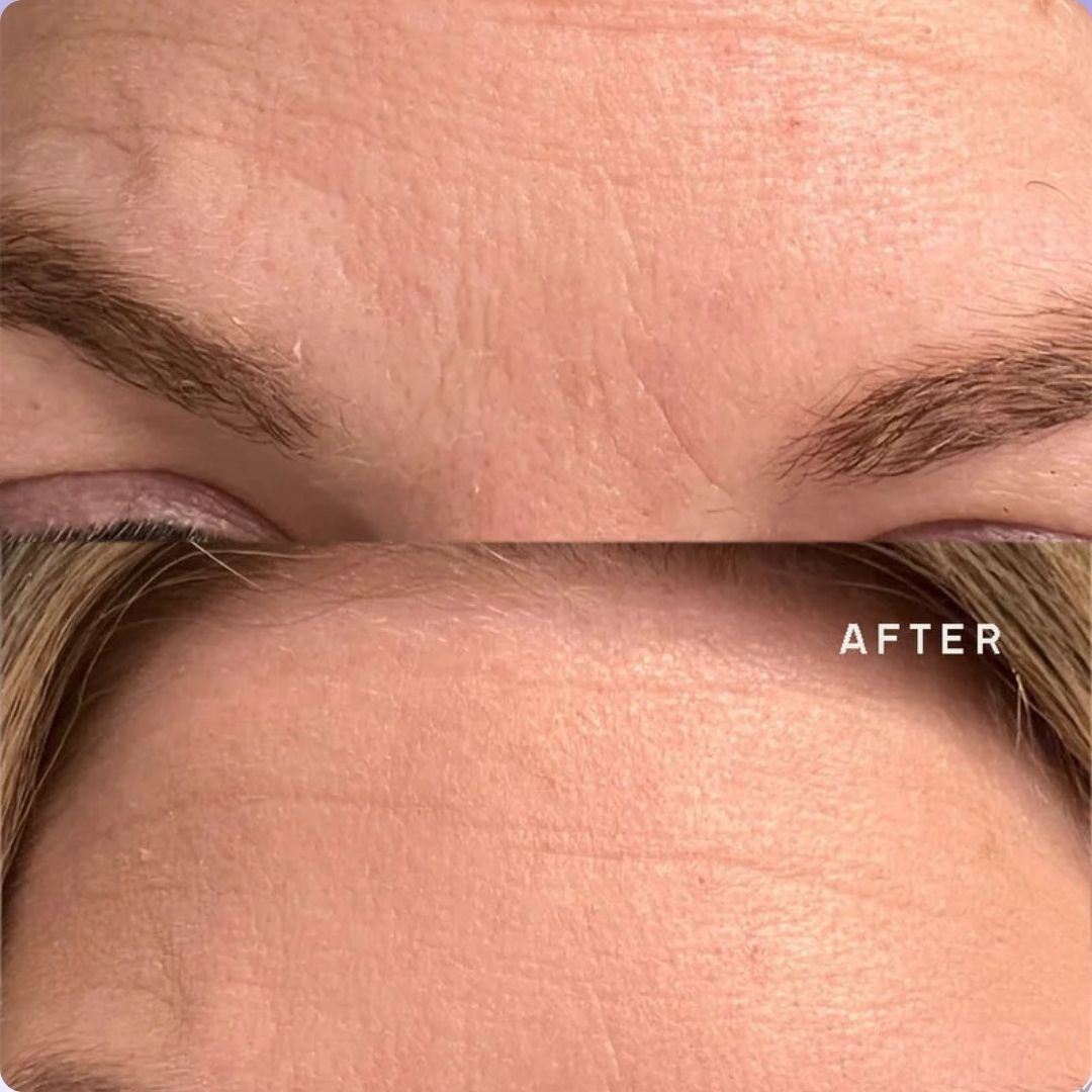 Popglow™ Wrinkle Patches